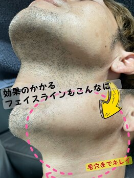 ブラックスワン(Black Swan)/MEN'S ひげ脱毛