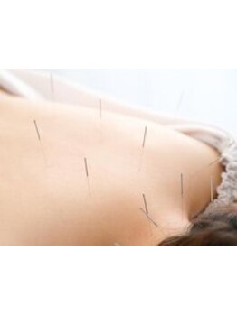 鍼灸施術を受けたい