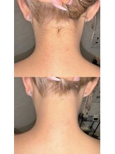 ワイズサロン(Y's salon)/うなじ脱毛