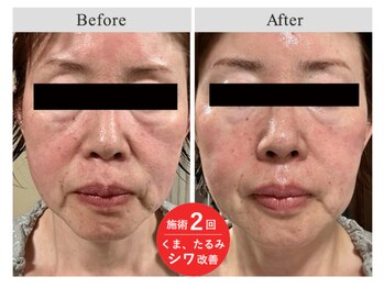 ボニータアンジュ 恵比寿(Bonita Ange)/恵比寿｜たるみ引き締め×小顔