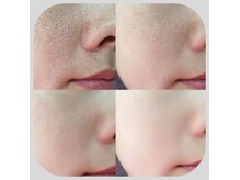エービューティー(A Beauty)の雰囲気（【肌質改善】即実感できるエイジングケア♪たるみ改善リセット◎）