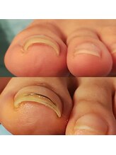フットケアサロン ラビフット(Rabbi foot)/爪の両端巻いたらワイヤーで即楽