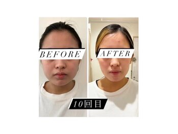 メディカルエステ 恵比寿店/＊インモード10回症例写真＊