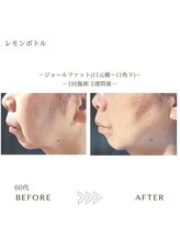 サロンエイトミー 西船橋店(salon 83)/レモンボトル/before→after