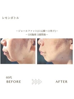 サロンエイトミー 西船橋店(salon 83)/レモンボトル/before→after