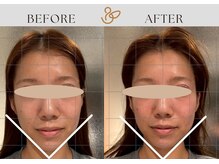 チョコバリ 渋谷店(chocobari)/小顔×リフトアップ(美容鍼)20代