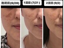 サロン ド アンジェリーナ(Salon de Angelina)/BBL+国産臍帯ヒト幹細胞でキレイ