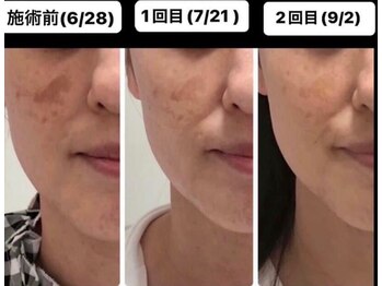 サロン ド アンジェリーナ(Salon de Angelina)/BBL+国産臍帯ヒト幹細胞でキレイ