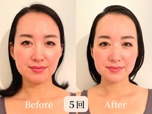 ロシュニ/40代 お悩み:たるみ/肋骨の厚み