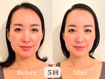 ロシュニ/40代 お悩み:たるみ/肋骨の厚み