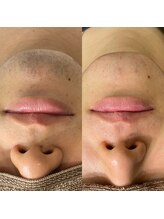 ウルル(ULuLu)/ヒゲ8回目Before→After