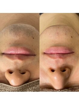 ウルル(ULuLu)/ヒゲ8回目Before→After