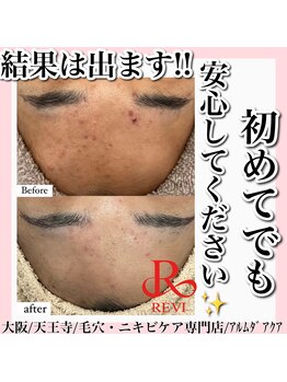 アルムダアクア 天王寺店(Aleumda AQUA)/ハーブピーリング/大阪/天王寺