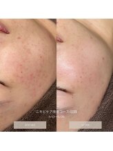 タグ 高知駅前店(Tug)/【ニキビケア・赤み】