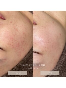 タグ 高知駅前店(Tug)/【ニキビケア・赤み】