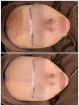 アンジェロ/【ニキビケア】肌育プログラム