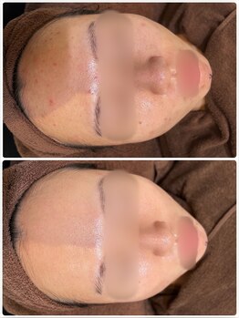 アンジェロ/【ニキビケア】肌育プログラム