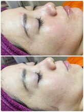 シャルム(CHARMER)/幹細胞入りハーブピーリング