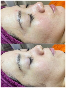 シャルム(CHARMER)/幹細胞入りハーブピーリング