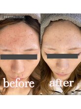 エッセンシャル アイビューティー(Essential)/プラズマシャワー Before→After