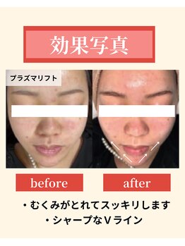 ナーズ(NAZ)/小顔コース