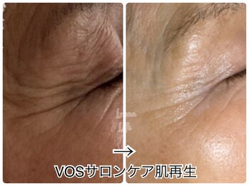 ルアナライフ(Luana Life)/年齢肌にこそ！VOS微細針の効果