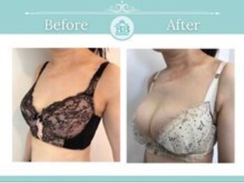 ベルビューティー(belle beauty)/【胸のたるみ・垂れ乳改善】症例