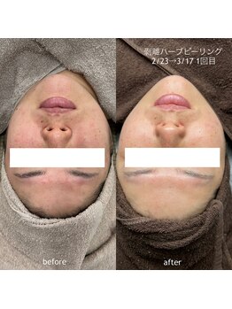 タグ 高知駅前店(Tug)/【ニキビケア・頬の毛穴・跡】