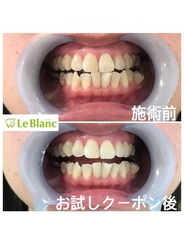 ルブラン 奈良店(Le Blanc)/照射回数を重ねて白くして