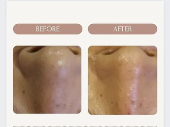 美々庵/ハイドラ 毛穴洗浄