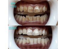ホワイトニングセンター 大阪京橋店/BeforeAfter