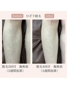 リードエピア(LEADepiA)/濃かった足の毛も効果バツグン