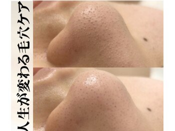 ブレア(Blair)/毛穴のお掃除