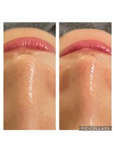 ルカシエ(Le Cacie)/20代女性/毛穴洗浄