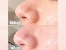 小顔・むくみ・たるみケアにフェイシャル引き締め♪毛穴も◎