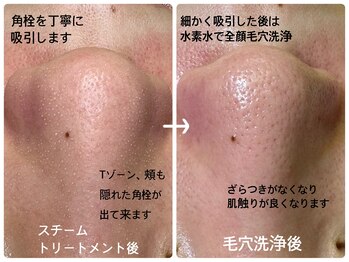 ルームエイトエイティスリー 新宿(R883)/鼻スチームトリートメントVol.2