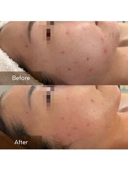 マヴィ(Mavie)/ニキビ　Before→After