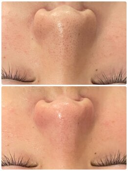 ルース(LUZ)/男性の毛穴悩みをトリプルでケア