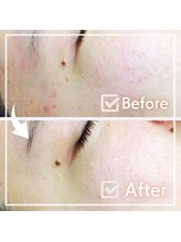 レイビス 盛岡店(RAYVIS)/ニキビケアに！小顔効果も♪