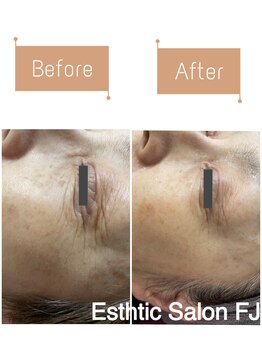 FJ/シワに働きかける◎フェイシャル