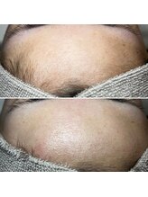 アーヒル(A”-HILU)/ワックス脱毛