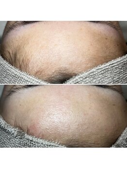 アーヒル(A”-HILU)/ワックス脱毛