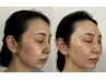 朝鏡を見るのが楽しみ【たるみ改善リフトアップ】短期集中コースの初回体験　