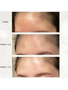 プラウディア(PROUDIA)/ハーブピーリング/ニキビケア