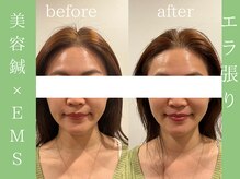 ビープラス(BEE PLUS)/エラ張り