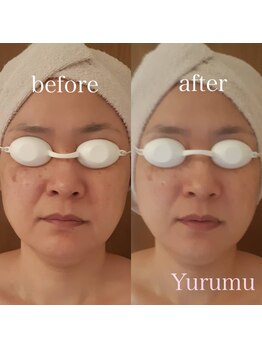 ユルム(Yurumu)の写真/【小顔/美白/乾燥/ほうれい線/フェイスライン/眼精疲労も◎】IPL光フェイシャル+小顔リフトUP＋ヘッド

