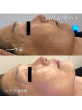 ラ ヴィレ ボーテ(La vraie beaute’)/before after