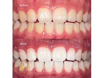 ラヴィス(RAVIS)/ホワイトニング白い歯って素敵♪