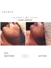 サロンエイトミー 西船橋店(salon 83)/レモンボトル/before→after