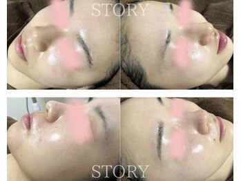ストーリー 岐阜店(STORY)/ハーブピーリング専門店STORY